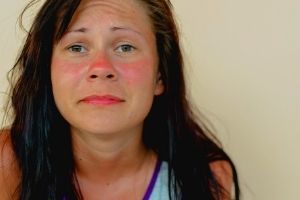 Red face rash